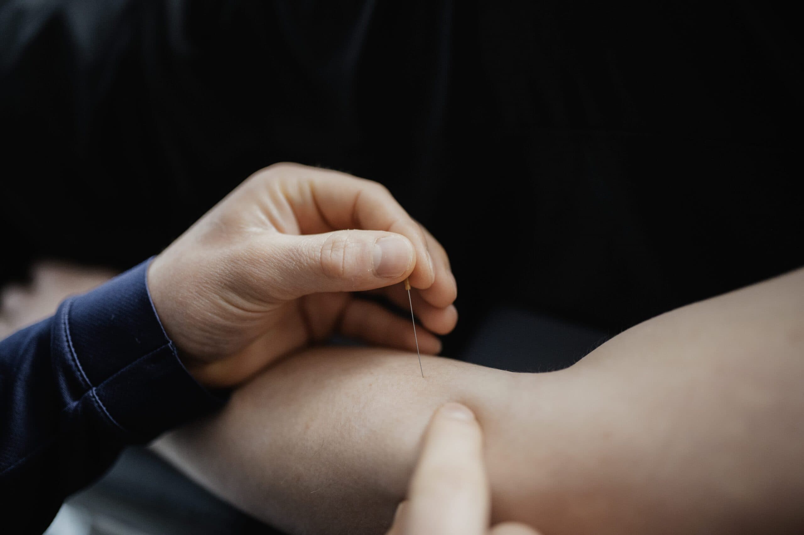 Dry needling foto